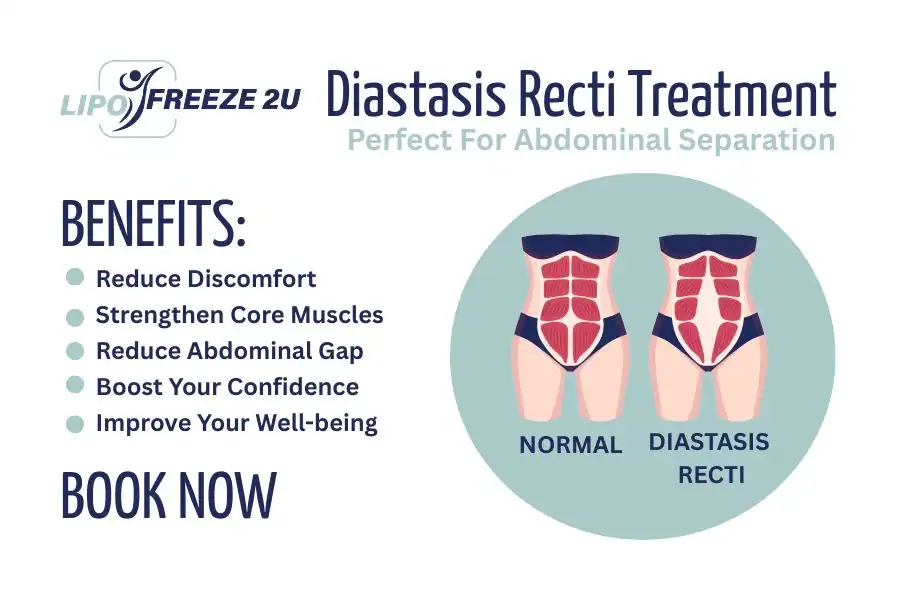 Benefits of body toning treatment Golders Green for Diastasis recti