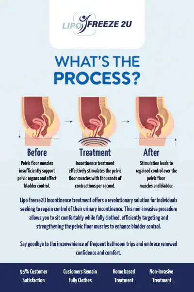 Diagram of how incontinence treatment Golders Green works.