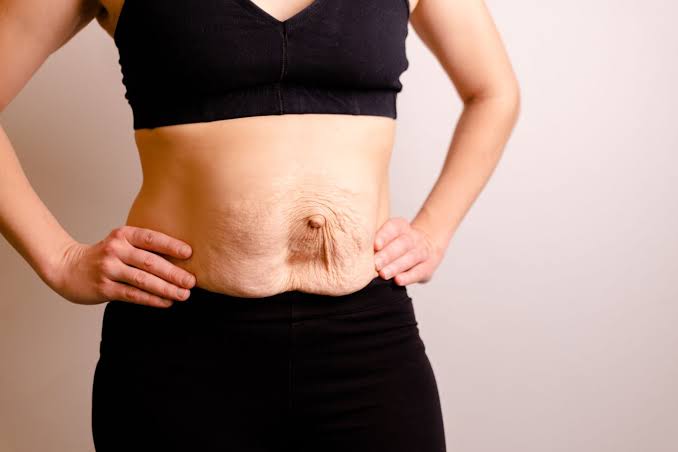 Is Surgery Really the Only Way to Repair Diastasis Recti Golders Green?